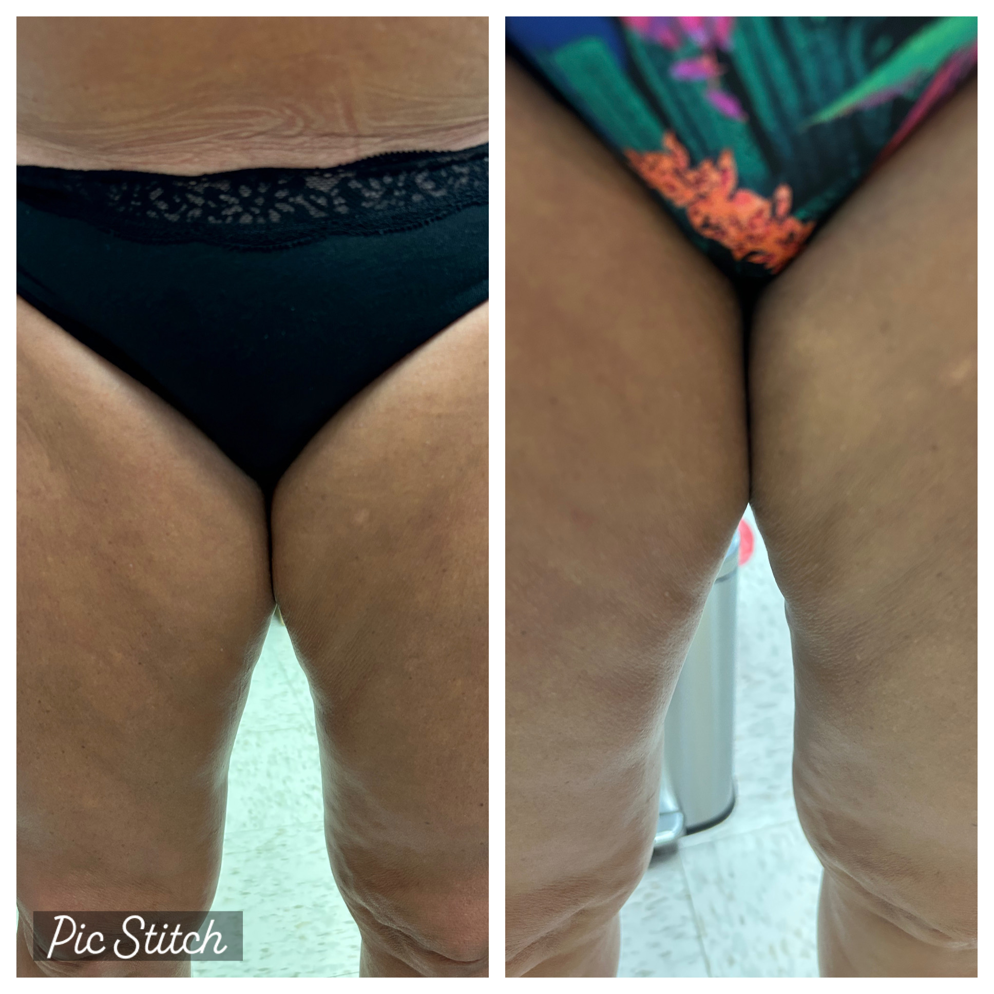 

Before and after photo of cellulite reduction using Morpheus8:

