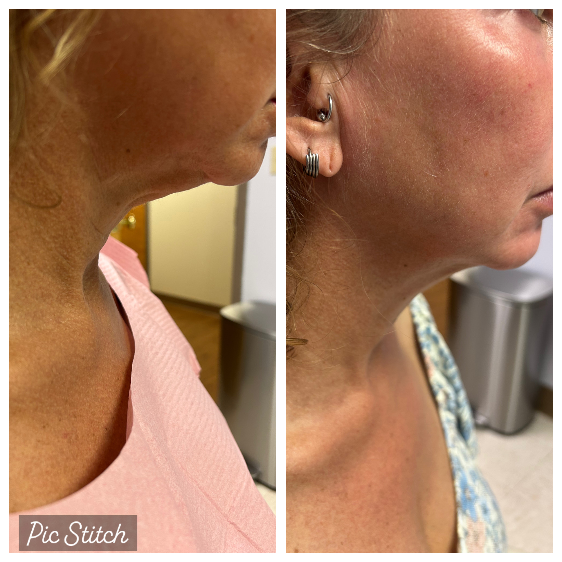 BEfore and after photos of QuantumRF