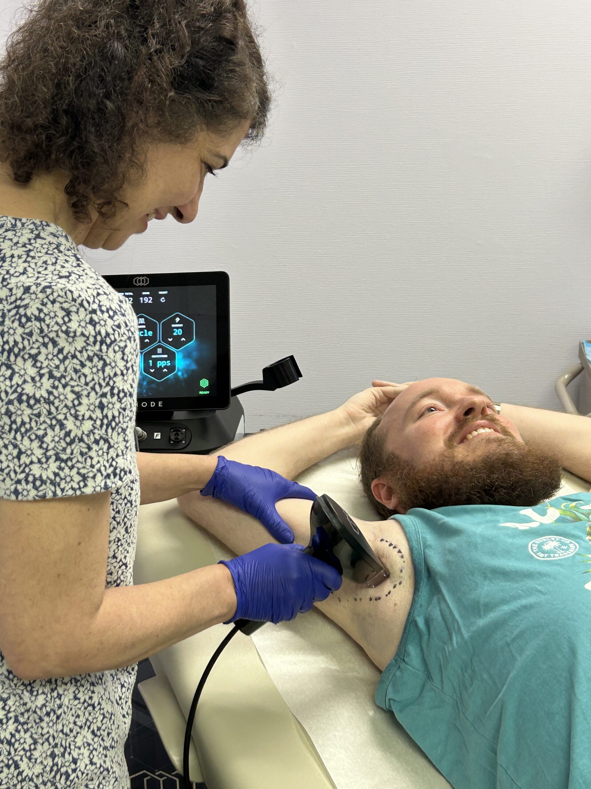 Photo of Patient undergoing Morpheus8 Treatment for underarm sweating