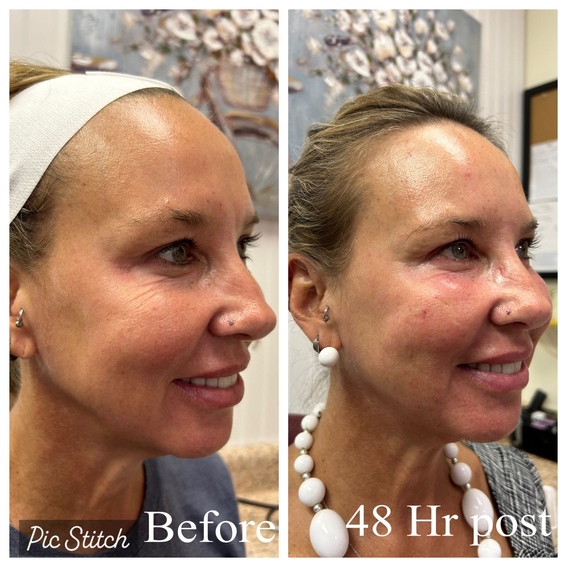 Before and After photo of Morpheus8