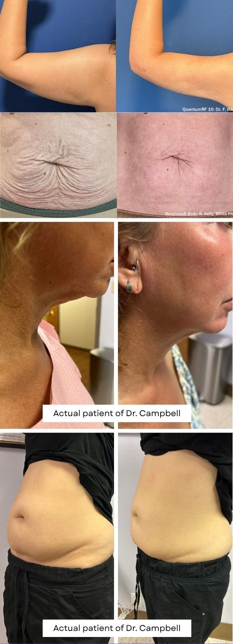 BEfore and after photos of QuantumRF
