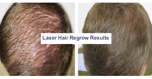 Before and After photos for Hair restoration treatments