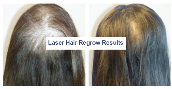 Before and After photos for Hair restoration treatments