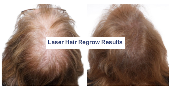 Before and After photos for Hair restoration treatments
