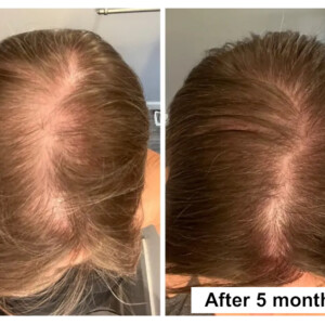 Photo of a patient's hair after 5 months of laser restoration treatments