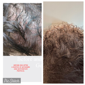 Before and after photos of hair restoration